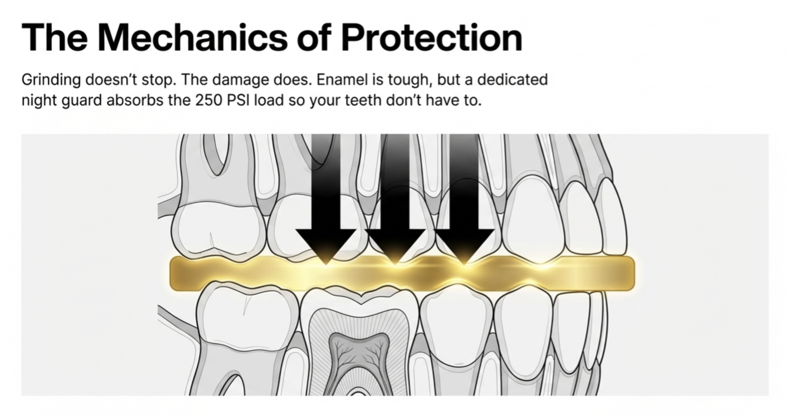 teeth grinding enamel damage vs night guard protection diagram