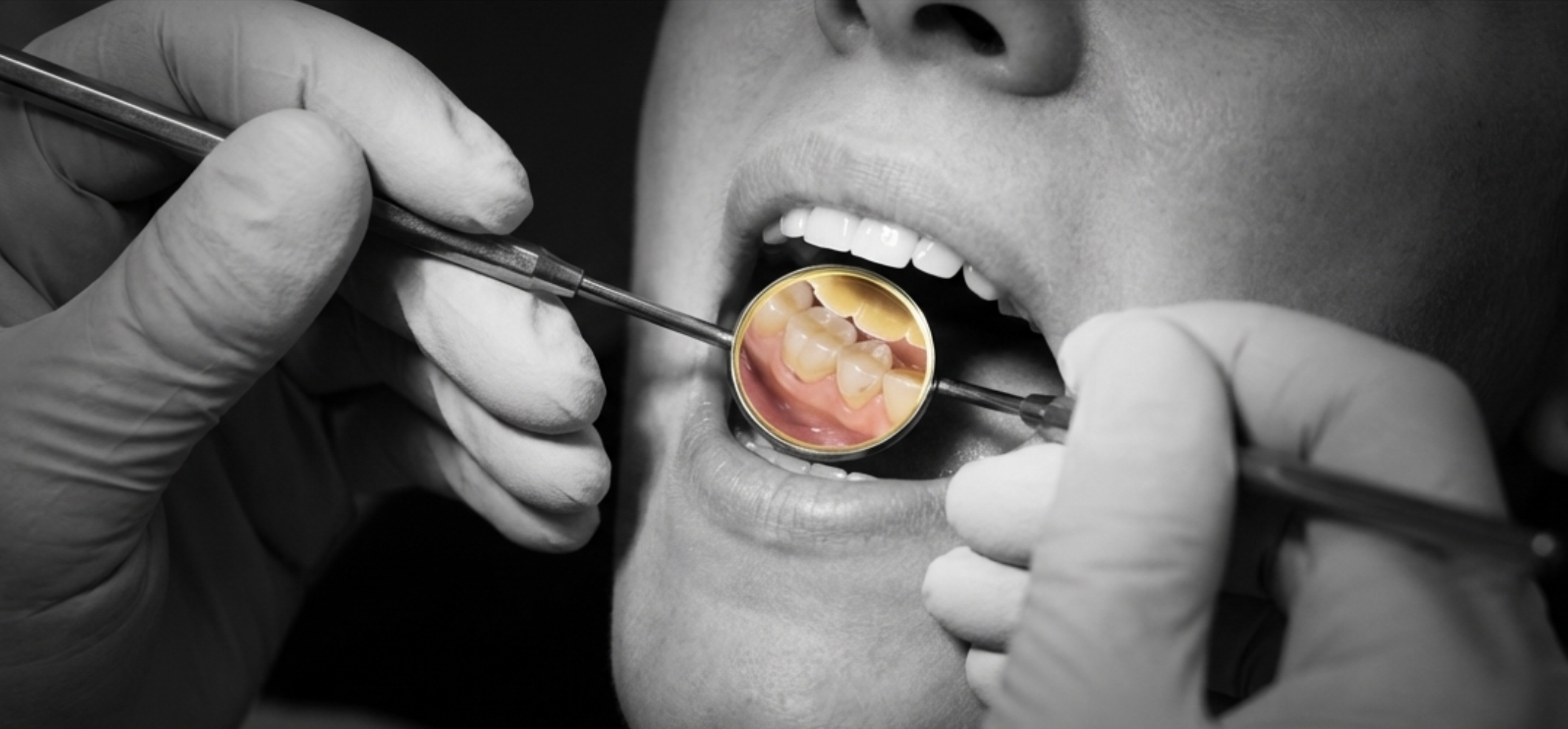 dentist examining teeth for bruxism enamel wear signs