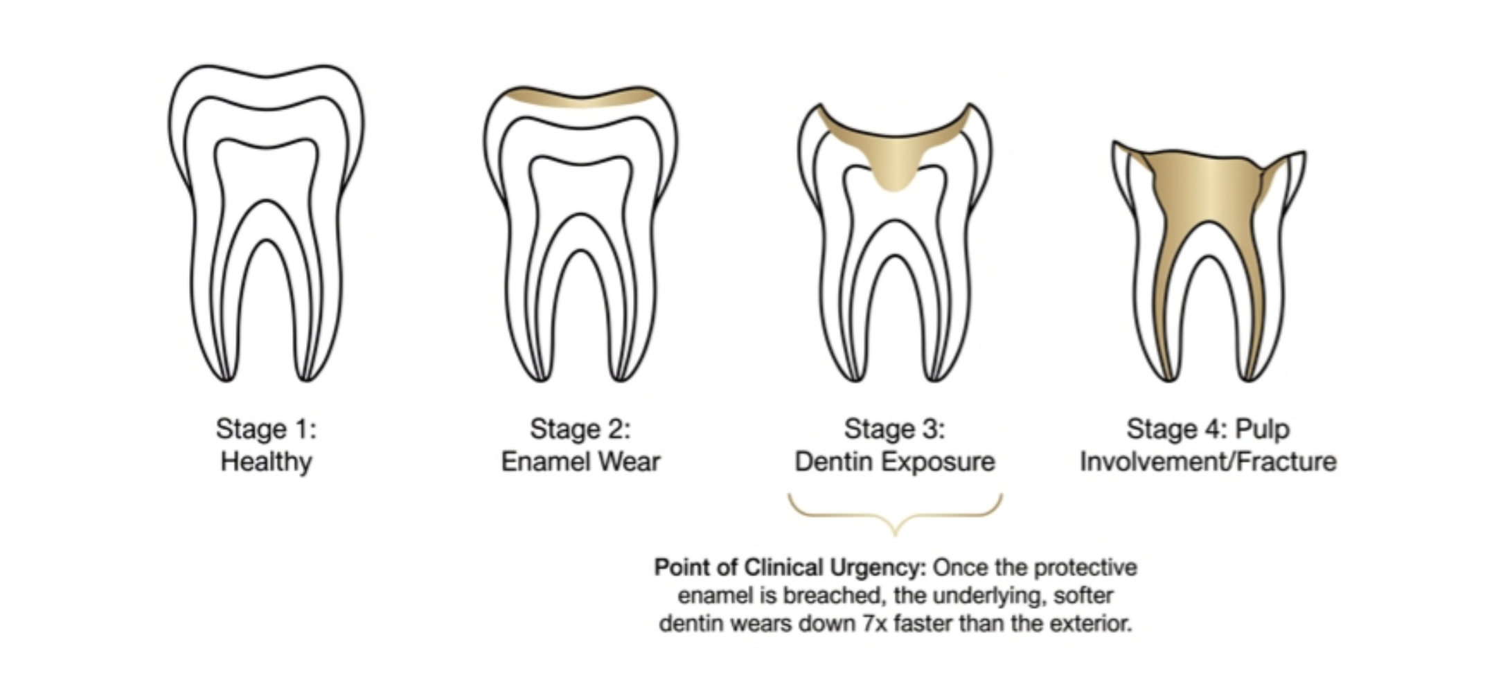 stages of tooth damage from untreated bruxism grinding
