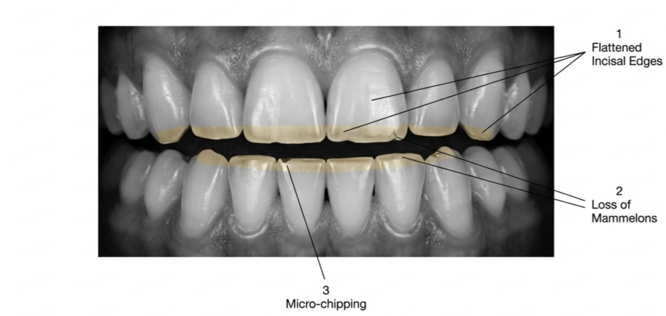 tooth enamel damage from bruxism teeth grinding