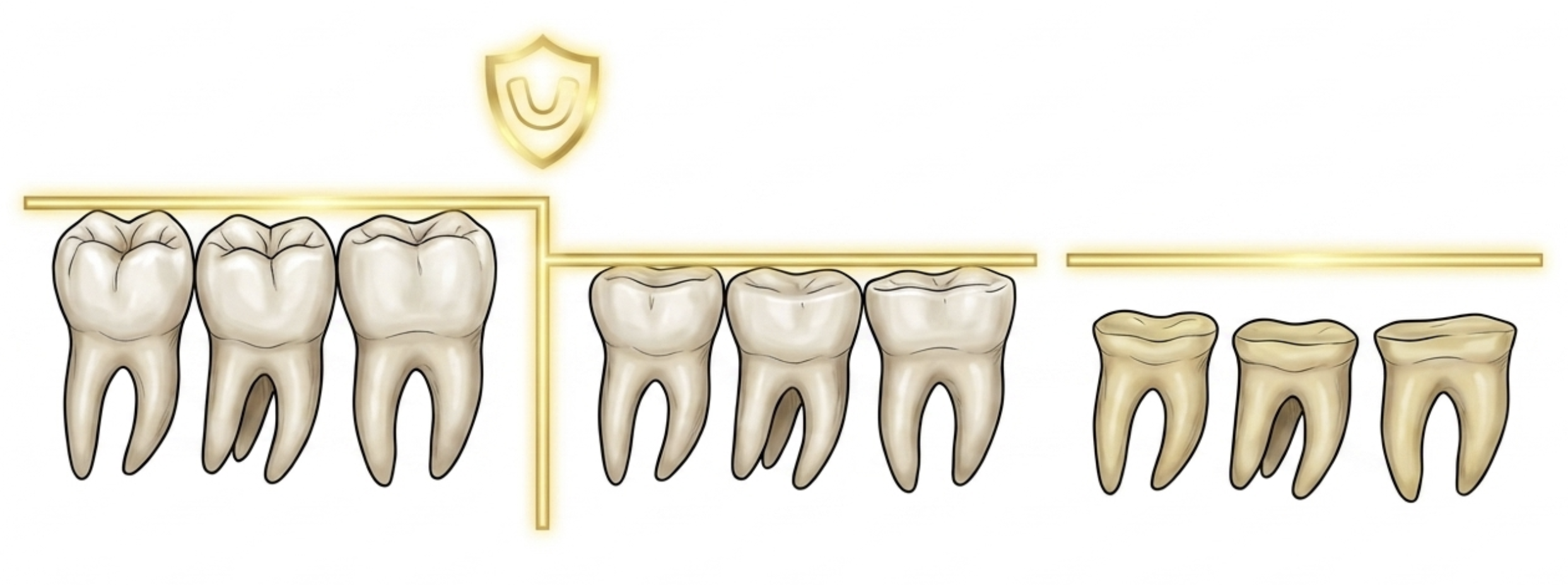 tooth wear progression from unprotected bruxism over years