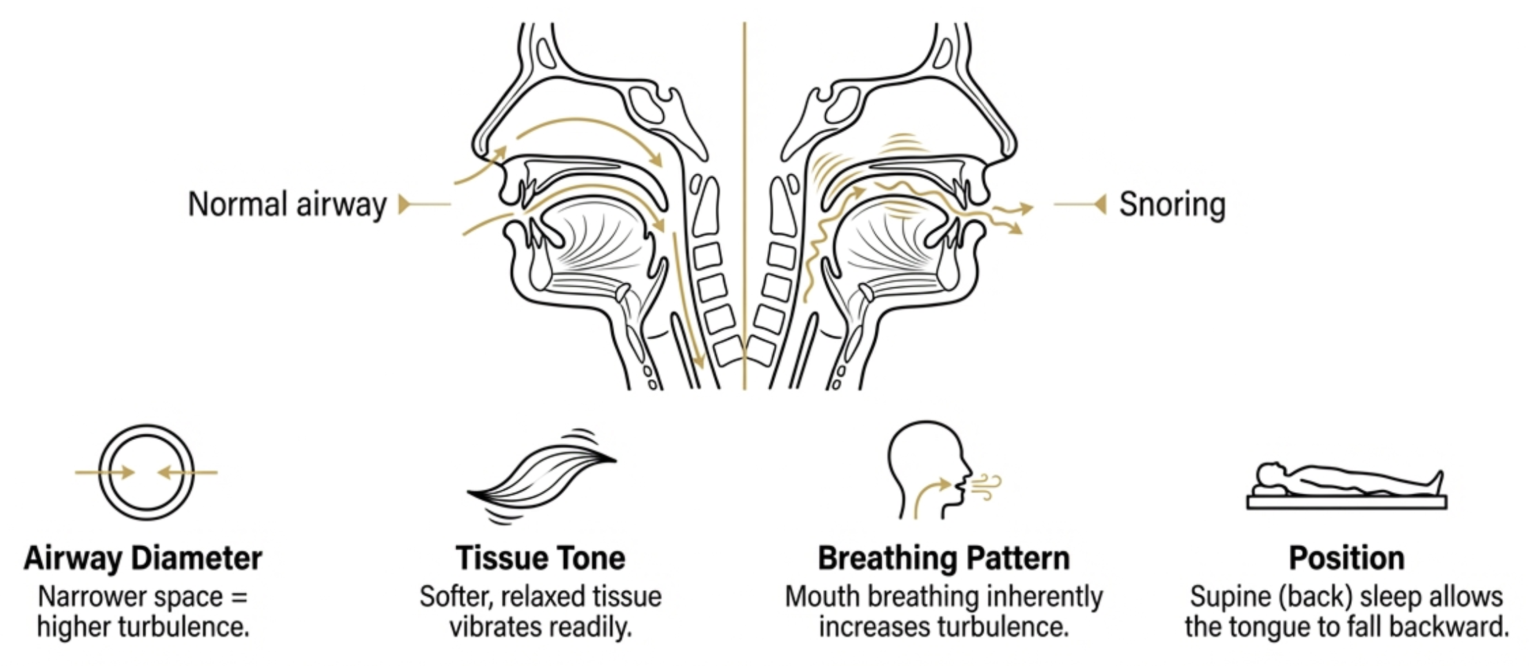 airway narrowing during snoring diagram soft palate vibration mechanism